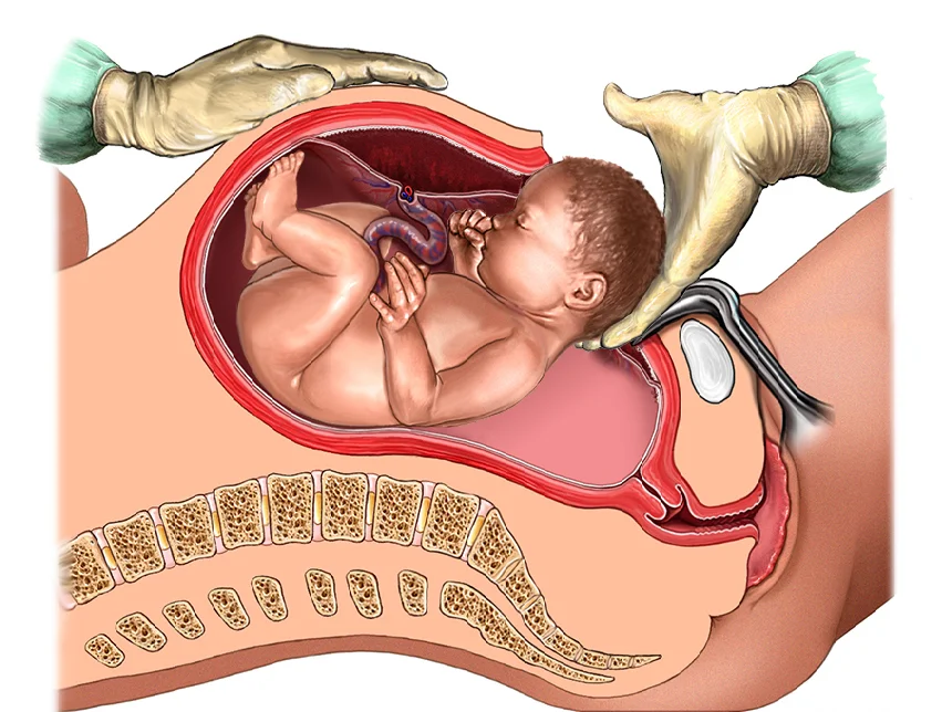Caesarean Section (C-Section) In Pune