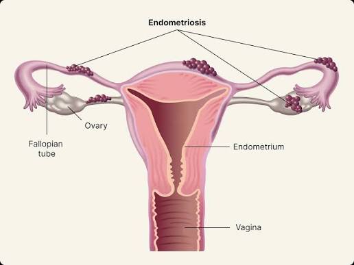 Endometriosis Management In Pune : Dr. Monika Thavare
