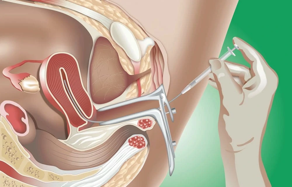 IUI Treatment in Pune