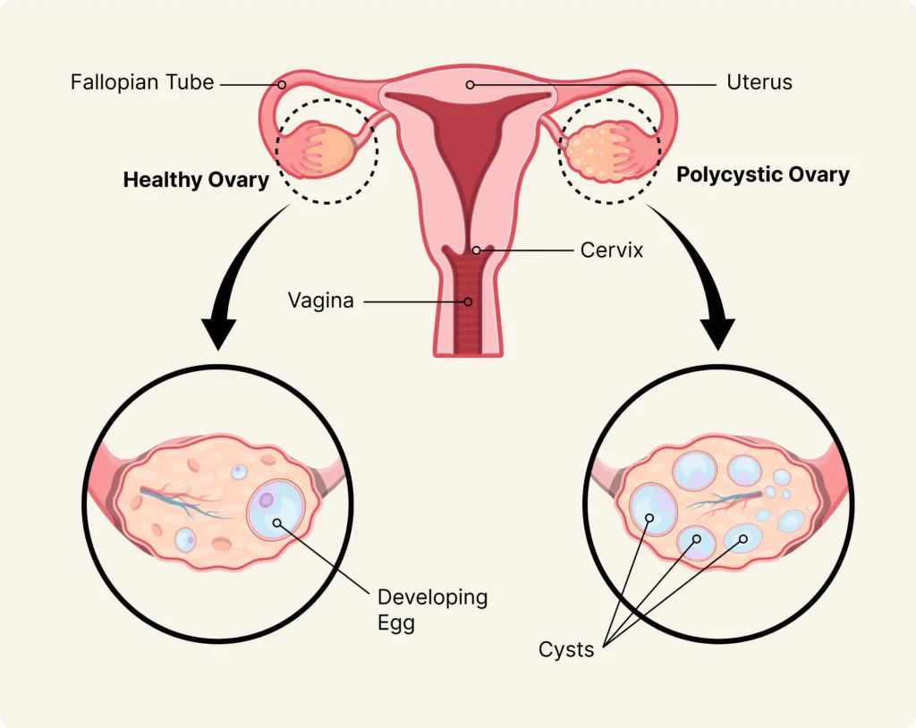 PCOS Infertility Management In Pune - Dr. Monika Thavare