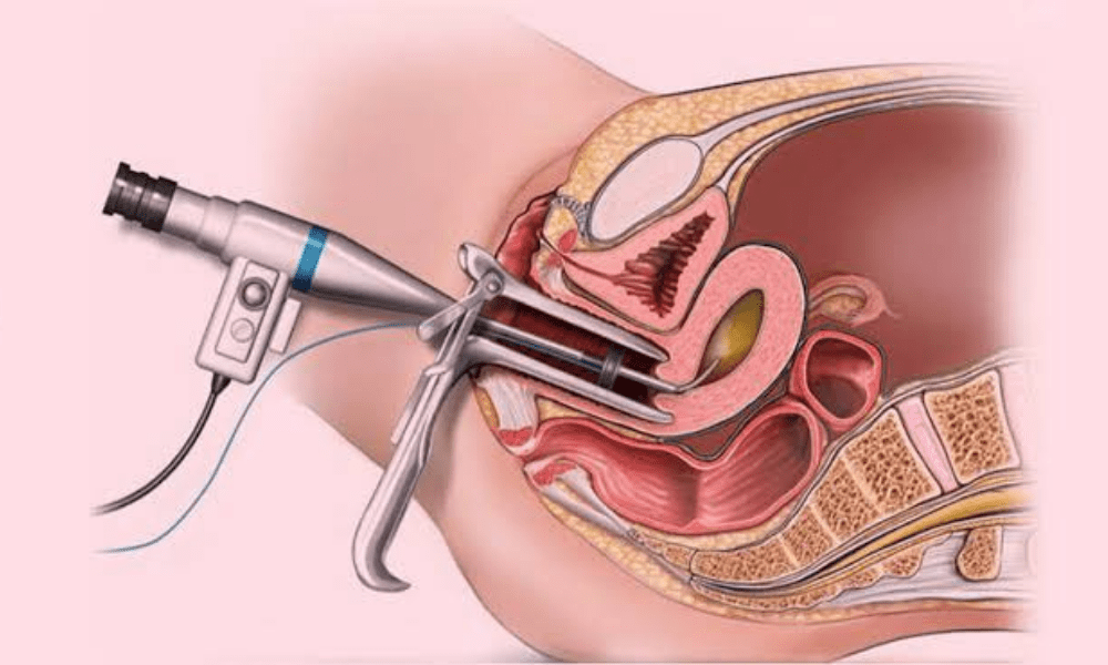 Surgical Treatments for Irregular Periods in Pune