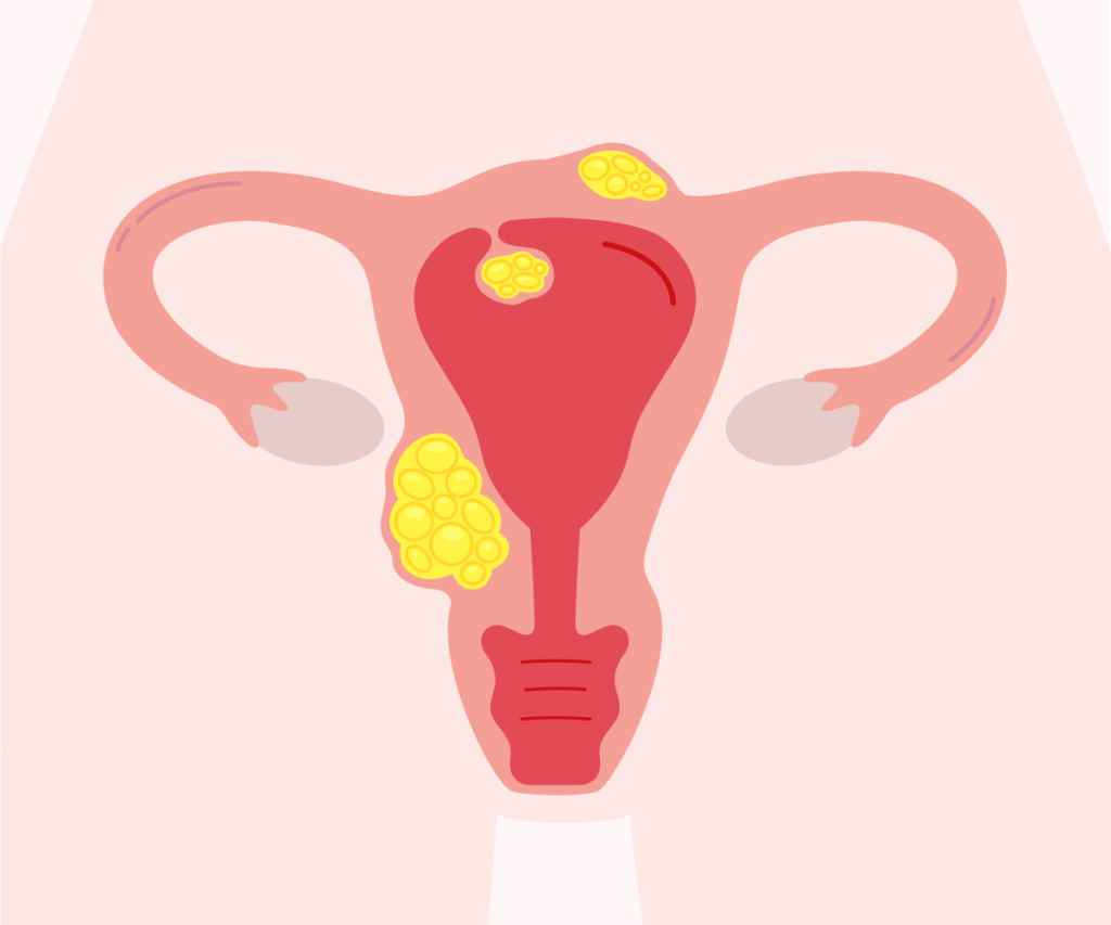 Uterine Fibroids Treatment in Pune