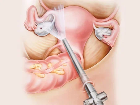 Laparoscopic Endometriosis Surgery in Pune