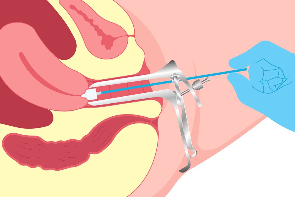 Pap Smear Test in Pune