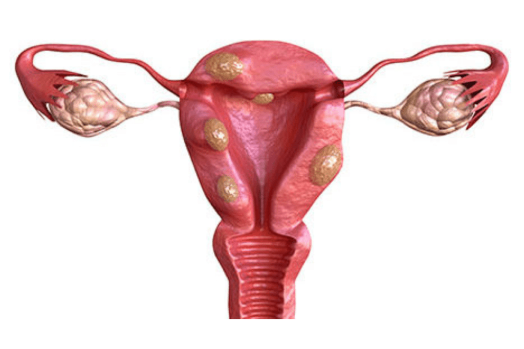 Uterine Fibroids Treatment in Pune