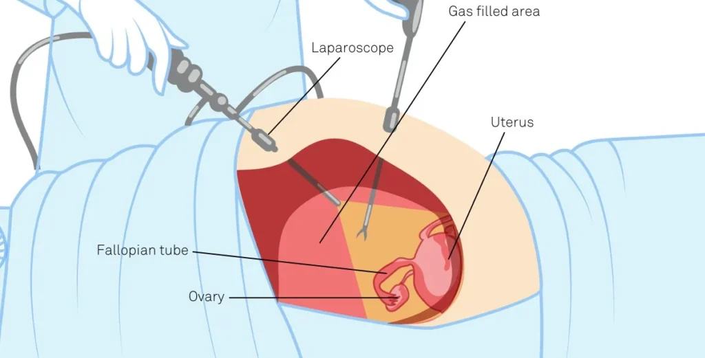 Diagnostic Laparoscopy In Pune
