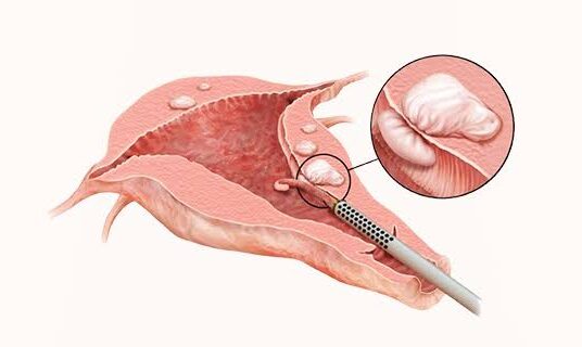 Laparoscopic Myomectomy In Pune
