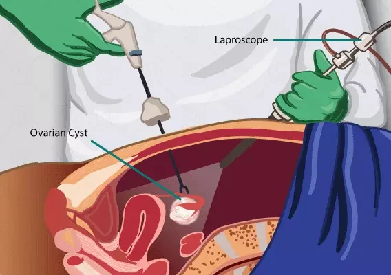 Laparoscopic Ovarian Cyst Surgery In Pune